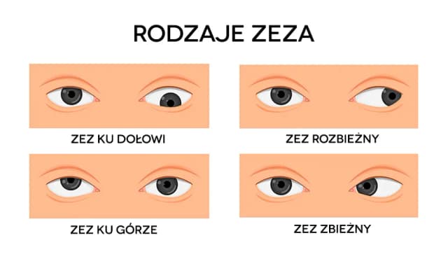 Jak wygląda zez? Poznaj objawy i charakterystyki tego schorzenia Jak wygląda zez? Poznaj objawy i charakterystyki tego schorzenia